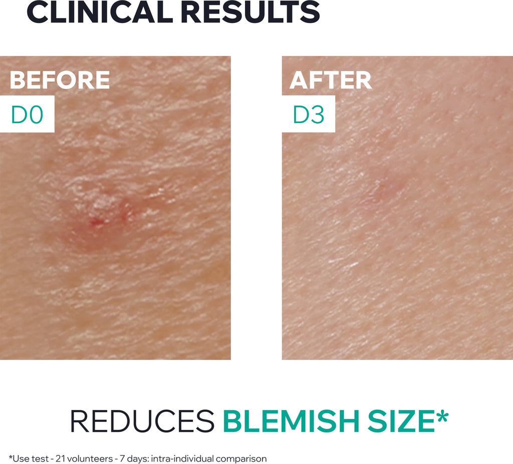 Hyseac SOS Paste For Blemishes 15g